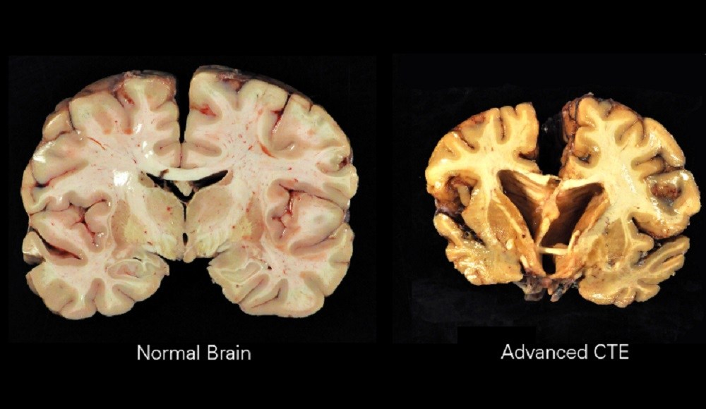 Brain disease affecting pro football players appears to be rare in the military, study suggests