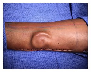 Soldier gets new ear after growing it on her arm