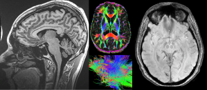 Study recruits troops to see how sleep deprivation affects the brain