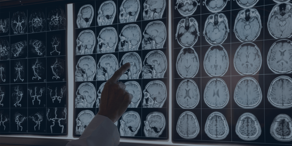 Traumatic brain injury signs can show up years later – but it’s not too late to seek care